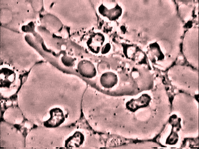 3 Parodontite. Amibe au centre complétant la phagocytose du noyau d un neutrophile. entourée de neutrophiles anesthésiés (apparence dégranulée)